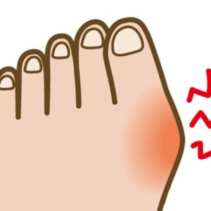 外反母趾について